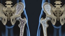 kosti, osteoporóza