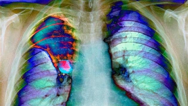 Snímek hrudi pacienta s rakovinou pravé plíce. Léčba nádoru zahrnuje radioterapie, chemoterapie a chirurgické odstranění postižené plíce nebo její části.