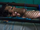 Podle OSN asi pětina venezuelských dětí trpí podvýživou.