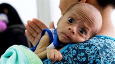 Francys Riverová se svým dvoumsíním synem trpícím podvýivou.  