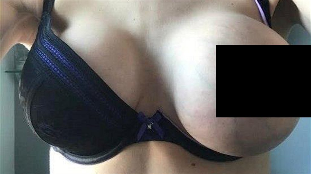 Ňadro jako meloun. Nebyla to rakovina, ale prasklý implantát