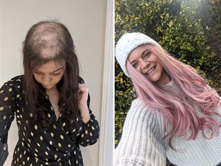 Hattie Gilfordová věří, že za pár měsíců vlasy dorostou a bude chodit bez...