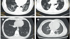 Ukázky napadených plic u pacient z jednoho rodinného klastru