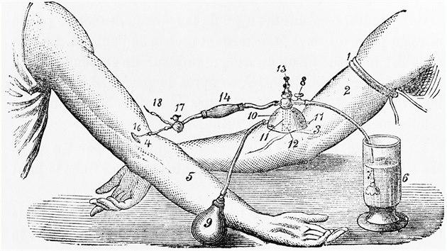 Nkres krevn transfuze z roku 1876