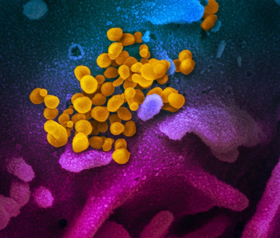 Snímek koronaviru SAR-CoV-2 (žlutě) z elektronového skenovacího mikroskopu....