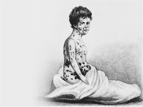 Ilustrace pacienta napadeného netovicemi z roku 1807