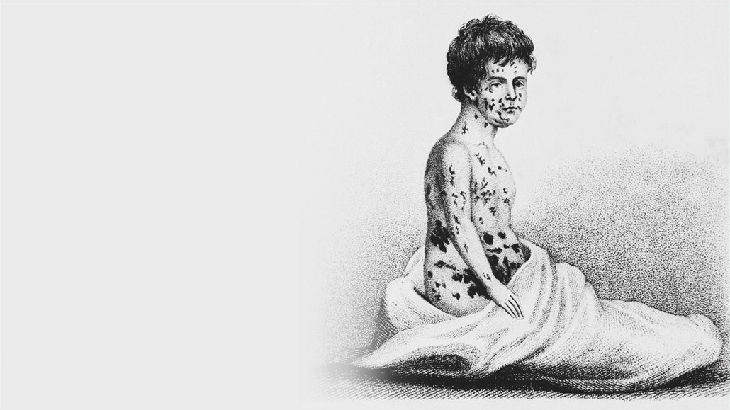 Ilustrace pacienta napadeného netovicemi z roku 1807