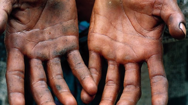 Rashid Begum, muž z oblasti Kamarpara v Bangladéši ruce ukazují charakteristické černé jizvy, příznak otravy arzénem. (15. června 2000)