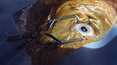 Operace šedého zákalu na pražské klinice Lexum pod vedením očního chirurga...