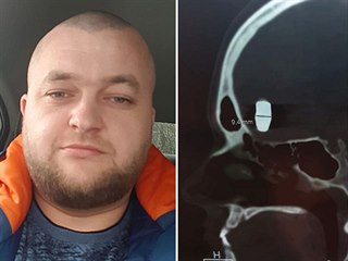 Vladimir Krutov žije deset let s kulkou v hlavě.