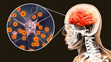 Klí��ová encefalitida � zán�tlivé onemocn�ní mozku a mozkových blan zp�sobené...