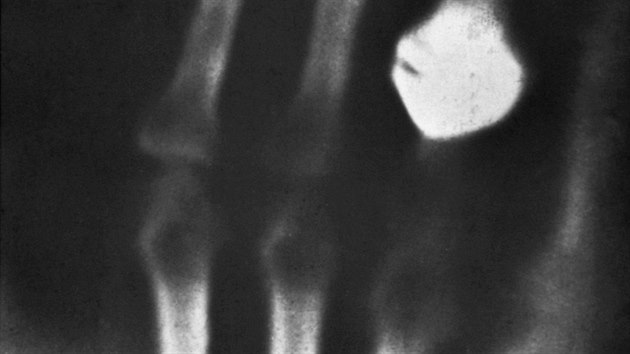 Prvn rentgenov snmek na svt z roku 1895 - ruka Rntgenovy eny s prstenem.