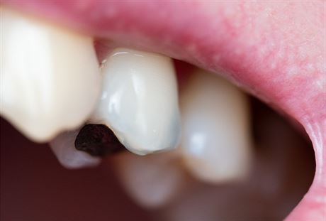 Amalganov plomby jsou jednou z pin praskn zub.