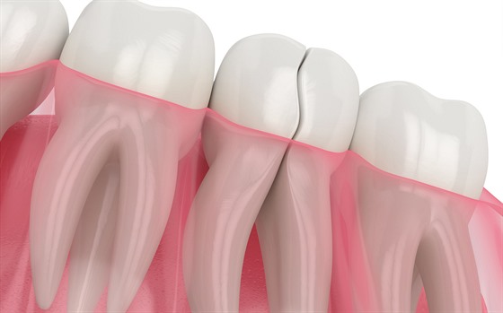 Prasklý zub může včas stomatolog odhalit. I proto jsou důležité preventivní...
