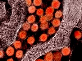 Elektronový mikroskop zachycuje virus SARS-CoV-2. Virová částice viru...