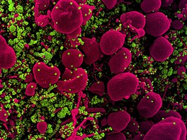 Buňky (fialová barva) těžce napadné virem SARS-CoV-2 (zelená barva)
