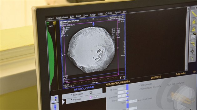 Bronzov poklad nechali archeologov prozkoumat potaovou tomografi v hradeck fakultn nemocnici.