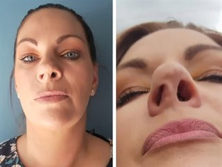 Louise z pořadu Botched