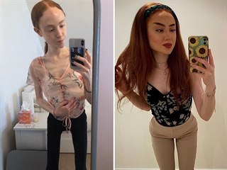Dívka zvítězila nad anorexií.