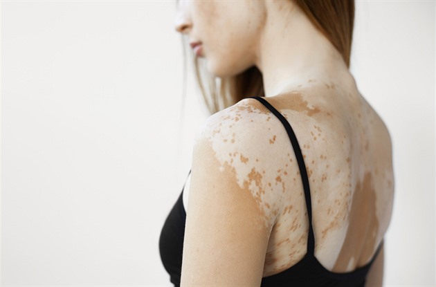 Nemoc bílých skvrn na kůži. Vitiligo dokáže ničit psychiku