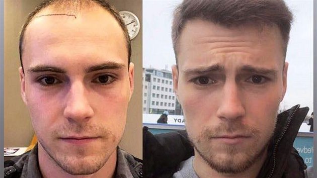Vítěz StarDance Dominik Vodička se na Instagramu svěřil s tím, že si v minulosti nechal transplantovat vlasy (2021).