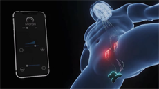 Morari transdermal neuromodulation patch