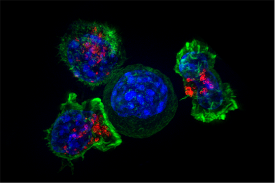 Lidské T-lymfocyty obklopují rakovinovou buku (ta jedna uprosted). (Barvy...