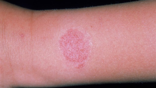 Kontaktn dermatitida, kter se objevila po noen hodinek. Kruhov erven vyrka na pacientov zpst je zpsoben alergi na nikl.
