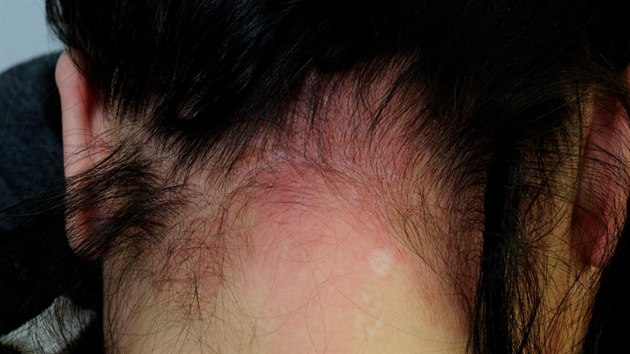 Zervenn a zancen ke (kontaktn dermatitida) na ji u pacientky v dsledku alergick reakce na barvu na vlasy.