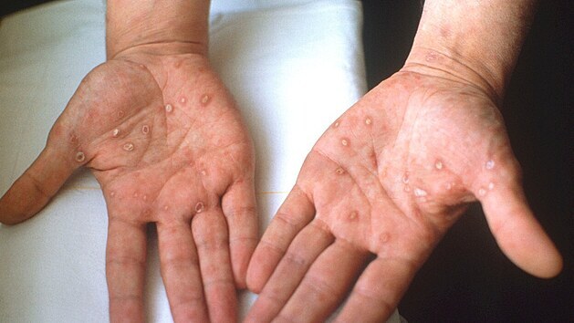 Sekundární syfilisová vyráka na dlaních