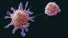 Bu�ky rakoviny prsu (ilustra�ní fotografie)