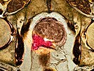 Snímek z magnetické rezonance, na kterém je vidt rakovina prostaty (ervené...
