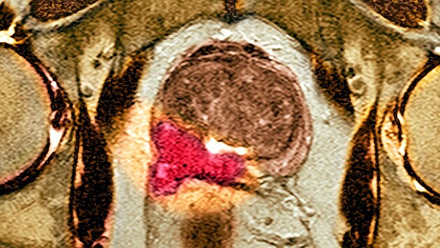 Snmek z magnetick rezonance, na kterm je vidt rakovina prostaty (erven msto).