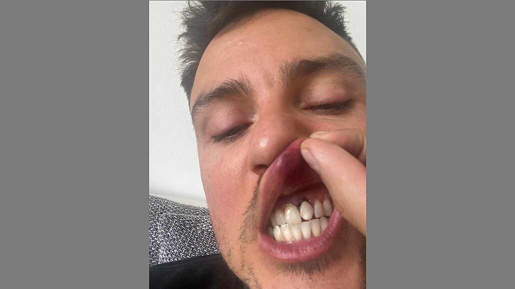 Jakub Starý po napadení v centru Prahy (2021)