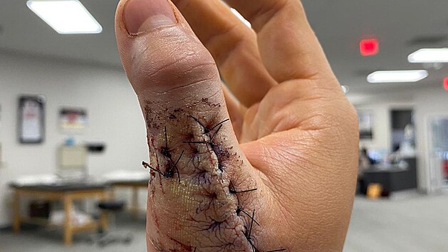 Palec brankáře Petra Mrázka po operaci