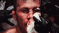 Zranění Stephana Pütze v zápase MMA.