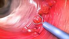 Ilustra�ní obrázek st�eva jiného pacienta s drobnými polypy zachycenými...