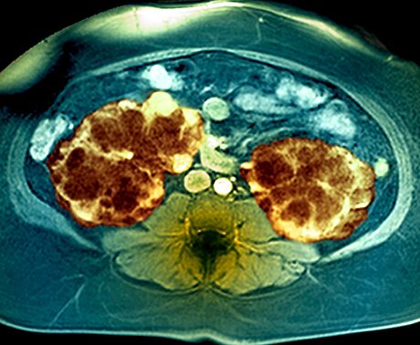 Polycystické ledviny - vyetení magnetickou rezonancí