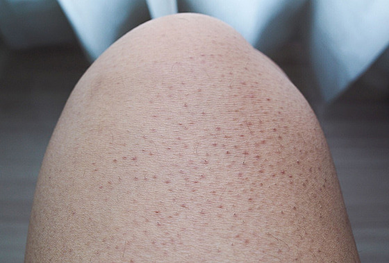 Keratóza pilaris - kožní nemoc