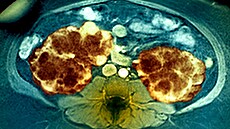 Polycystické ledviny - vyšetření magnetickou rezonancí