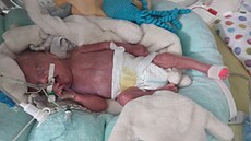 Malý Matěj přišel na svět ve 23. týdnu těhotenství, vážil 730 gramů a v...