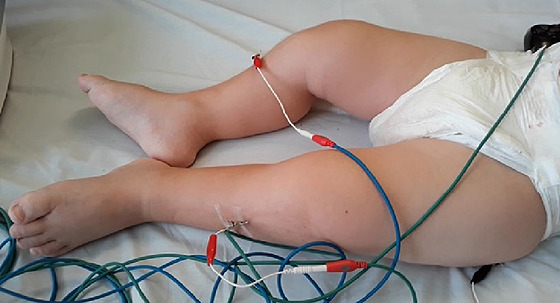 Ukázka elektroakupunktury na dětském pacientovi v léčebně Vesna v Janských...