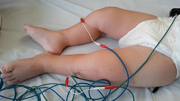 Ukázka elektroakupunktury na dětském pacientovi v léčebně Vesna v Janských Lázních.