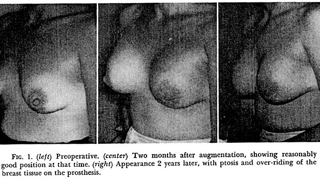 Amerianka Timmie Jean Lindsey je prvn enou, kter 16. bezna 1962 spn voperovali silikonov implantty.