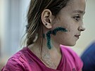Jedenáctiletá dívka Milena, která byla zranna pi ostelování Mariupolu,...