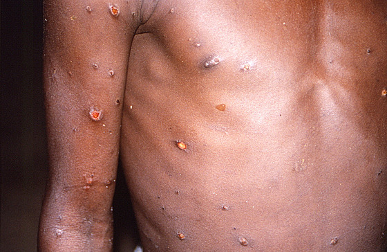 Opičí neštovice neboli monkeypox je virové onemocnění, které se podobá pravým...