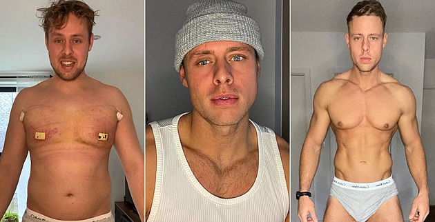 Muži kvůli steroidům narostla prsa, po operaci sdílel svou proměnu