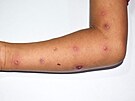 Opií netovice neboli monkeypox je virové onemocnní, které se podobá pravým...