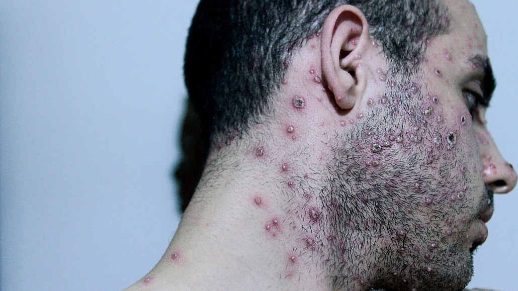 Opi�í ne�tovice neboli monkeypox je virové onemocn�ní, které se podobá pravým...