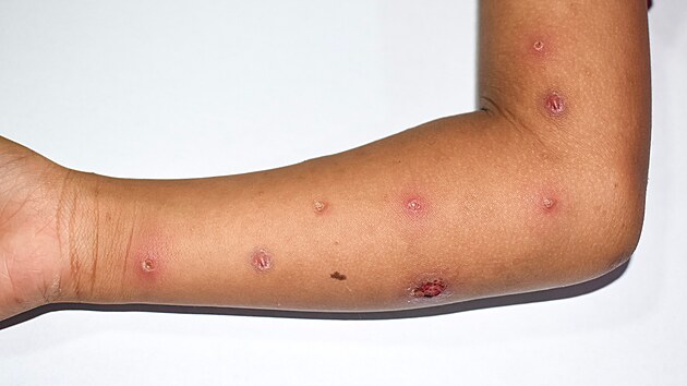 Opi netovice neboli monkeypox je virov onemocnn, kter se podob pravm netovicm, ale je mrnj. Zpsobuje ho virus rodu Orthopoxvirus z eledi Poxviridae.